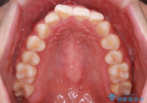 【インビザライン】前歯のねじれを治したい。の治療前