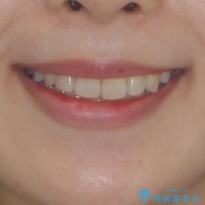 デコボコで磨きにくい歯列　ワイヤー装置での抜歯矯正で歯磨きをしやすくの治療後（顔貌）