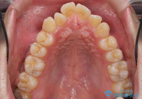 出っ歯をしっかり引っ込めたいの治療前