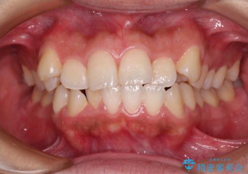 くちばしのような前歯が気になる　ワイヤー装置による抜歯矯正治療の症例 治療前