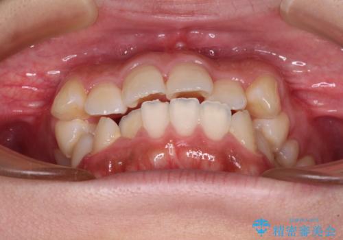 くちばしのような前歯が気になる　ワイヤー装置による抜歯矯正治療の治療前