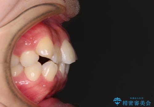 くちばしのような前歯が気になる ワイヤー装置による抜歯矯正治療の治療前