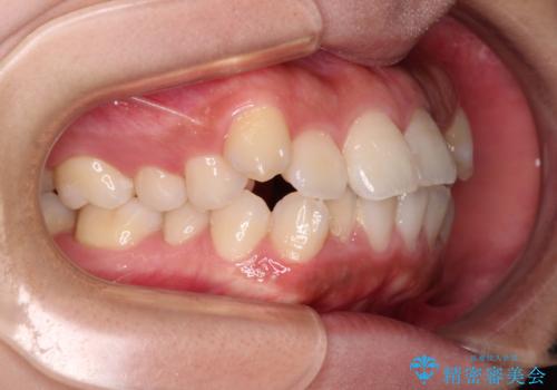 くちばしのような前歯が気になる ワイヤー装置による抜歯矯正治療の治療前