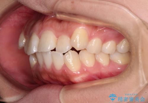 くちばしのような前歯が気になる ワイヤー装置による抜歯矯正治療の治療前
