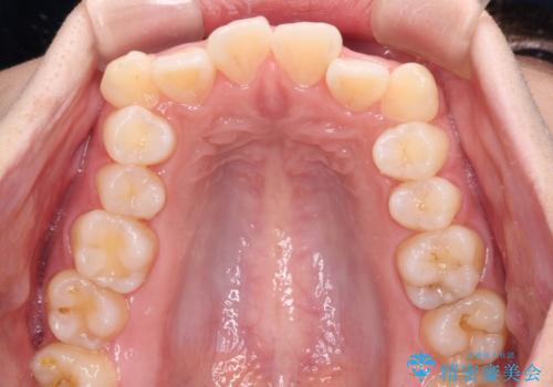 くちばしのような前歯が気になる ワイヤー装置による抜歯矯正治療の治療前
