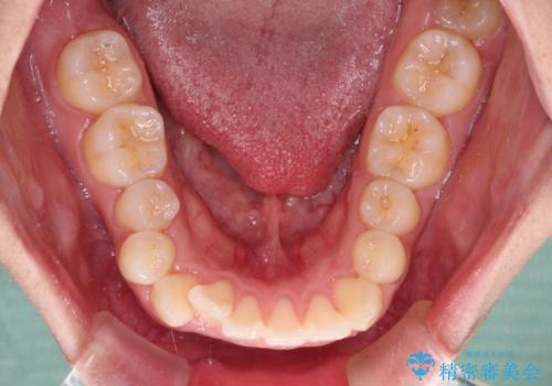 くちばしのような前歯が気になる　ワイヤー装置による抜歯矯正治療の治療前