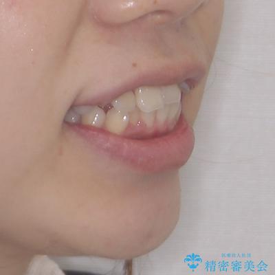 くちばしのような前歯が気になる　ワイヤー装置による抜歯矯正治療の治療前（顔貌）