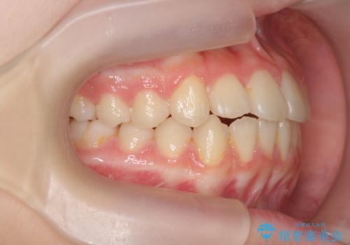 [ 前歯のねじれ改善 ]   中学生に行う早期マウスピース矯正治療の治療後