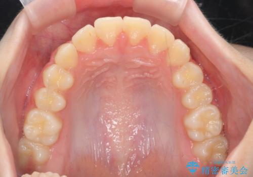 [ 前歯のねじれ改善 ]   中学生に行う早期マウスピース矯正治療の治療後