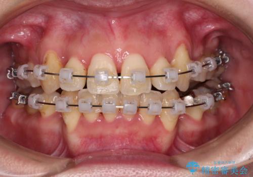 【モニター】上下の八重歯を治したい　ワイヤー装置による矯正治療の治療中