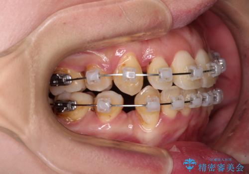 【モニター】上下の八重歯を治したい ワイヤー装置による矯正治療の治療中