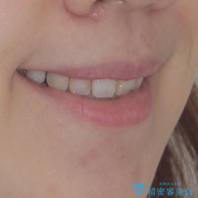 出っ歯と奥歯の欠損　ワイヤー矯正とインプラント治療の治療後（顔貌）