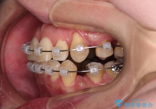 【モニター】上下の八重歯を治したい ワイヤー装置による矯正治療の治療中