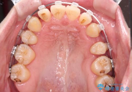 【モニター】上下の八重歯を治したい ワイヤー装置による矯正治療の治療中