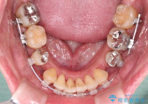 【モニター】上下の八重歯を治したい　ワイヤー装置による矯正治療の治療中