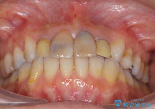 黒ずんだ見栄えの悪い前歯をきれいにしたいの治療前