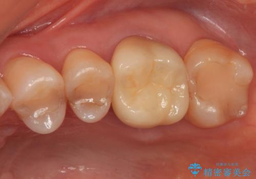 境目にものが詰まって気になる オールセラミッククラウン治療の症例 治療前