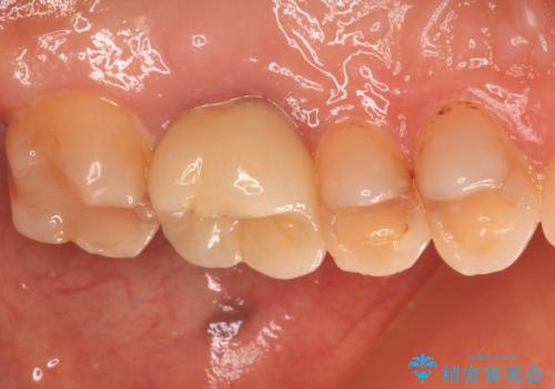 境目にものが詰まって気になる オールセラミッククラウン治療の治療前