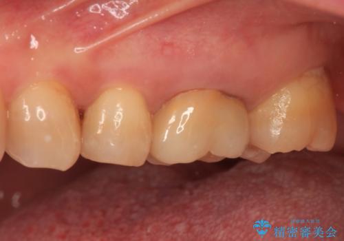 境目にものが詰まって気になる オールセラミッククラウン治療の治療前