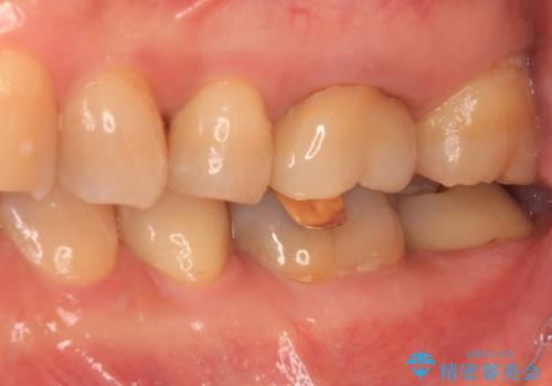 境目にものが詰まって気になる オールセラミッククラウン治療の治療前