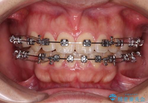 気がつくと唇が開く 口元を下げる抜歯矯正の治療中
