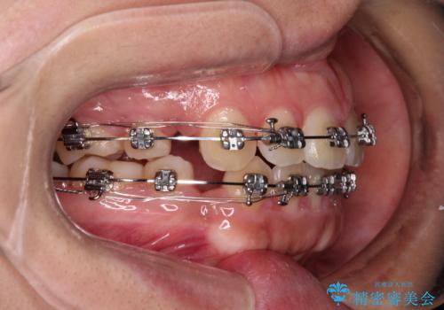 気がつくと唇が開く 口元を下げる抜歯矯正の治療中