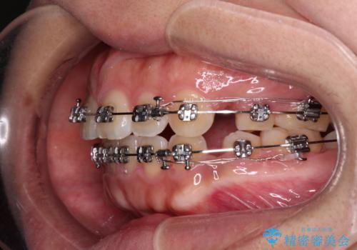 気がつくと唇が開く 口元を下げる抜歯矯正の治療中