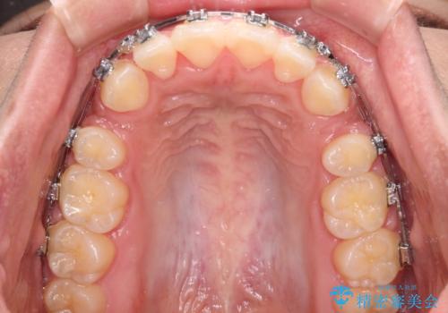 気がつくと唇が開く 口元を下げる抜歯矯正の治療中