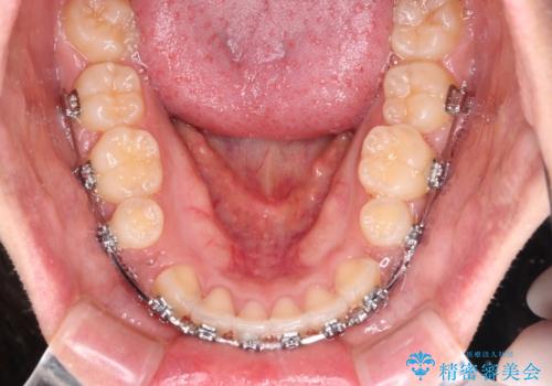 気がつくと唇が開く 口元を下げる抜歯矯正の治療中