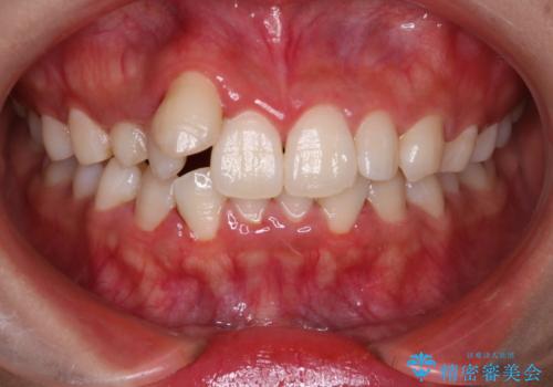 【インビザライン】八重歯が気になるの症例 治療前