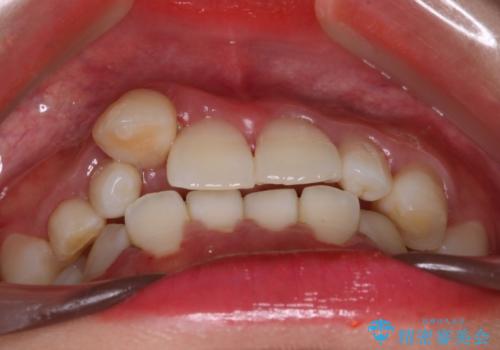 【インビザライン】八重歯が気になるの治療前