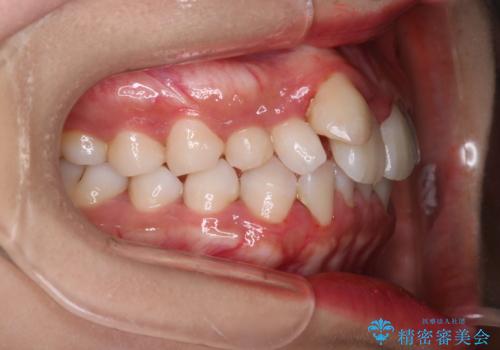 【インビザライン】八重歯が気になるの治療前