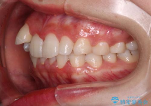 【インビザライン】八重歯が気になるの治療前