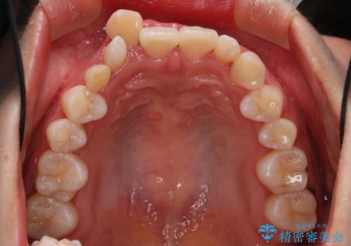 【インビザライン】八重歯が気になるの治療前