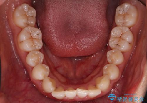 【インビザライン】八重歯が気になるの治療前