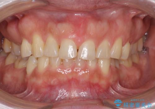 50代女性 部分矯正で 前歯の見た目改善 気になるところだけの症例 治療後
