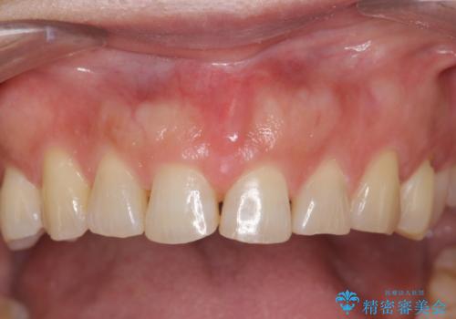 50代女性　部分矯正で　前歯の見た目改善　気になるところだけの治療後