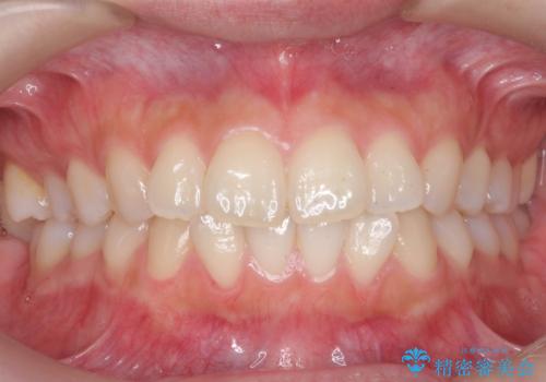 [ インビザライン ]  前歯のがたつきを綺麗に並べたいの治療前