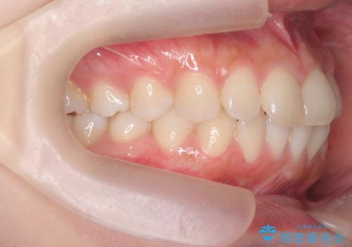 [ インビザライン ]  前歯のがたつきを綺麗に並べたいの治療前