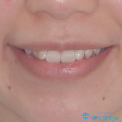 前歯のガタガタを整えたい　ワイヤー装置による抜歯矯正治療の治療前（顔貌）