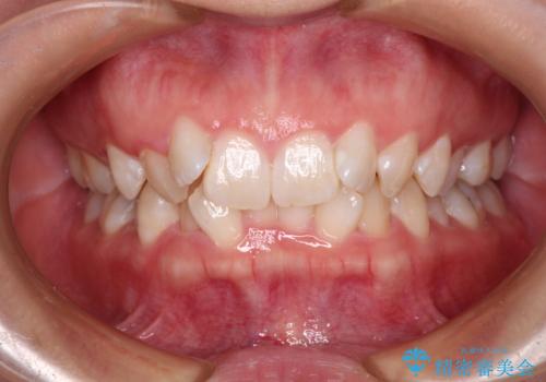 前歯のガタガタを整えたい ワイヤー装置による抜歯矯正治療の症例 治療前