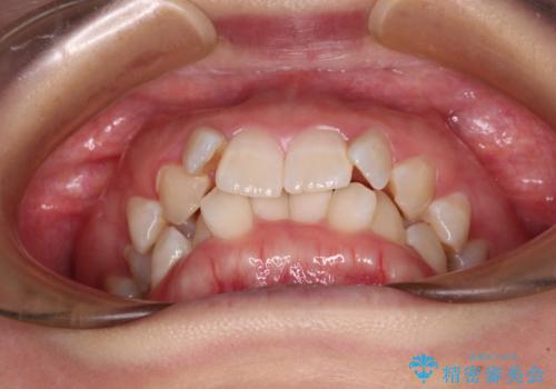 前歯のガタガタを整えたい ワイヤー装置による抜歯矯正治療の治療前