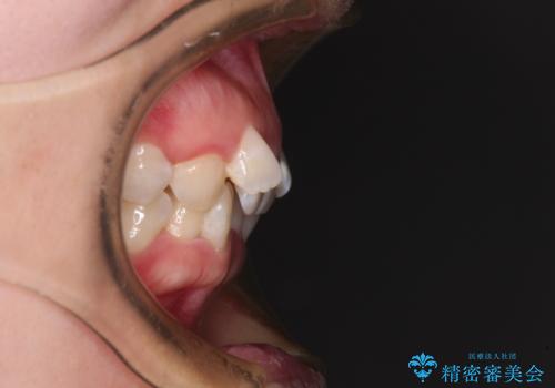 前歯のガタガタを整えたい ワイヤー装置による抜歯矯正治療の治療前