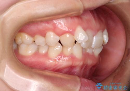 前歯のガタガタを整えたい ワイヤー装置による抜歯矯正治療の治療前