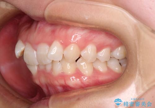 前歯のガタガタを整えたい　ワイヤー装置による抜歯矯正治療の治療前