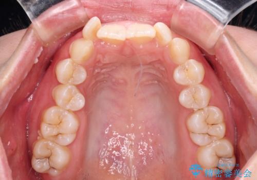 前歯のガタガタを整えたい ワイヤー装置による抜歯矯正治療の治療前