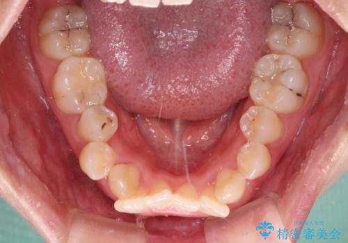前歯のガタガタを整えたい ワイヤー装置による抜歯矯正治療の治療前