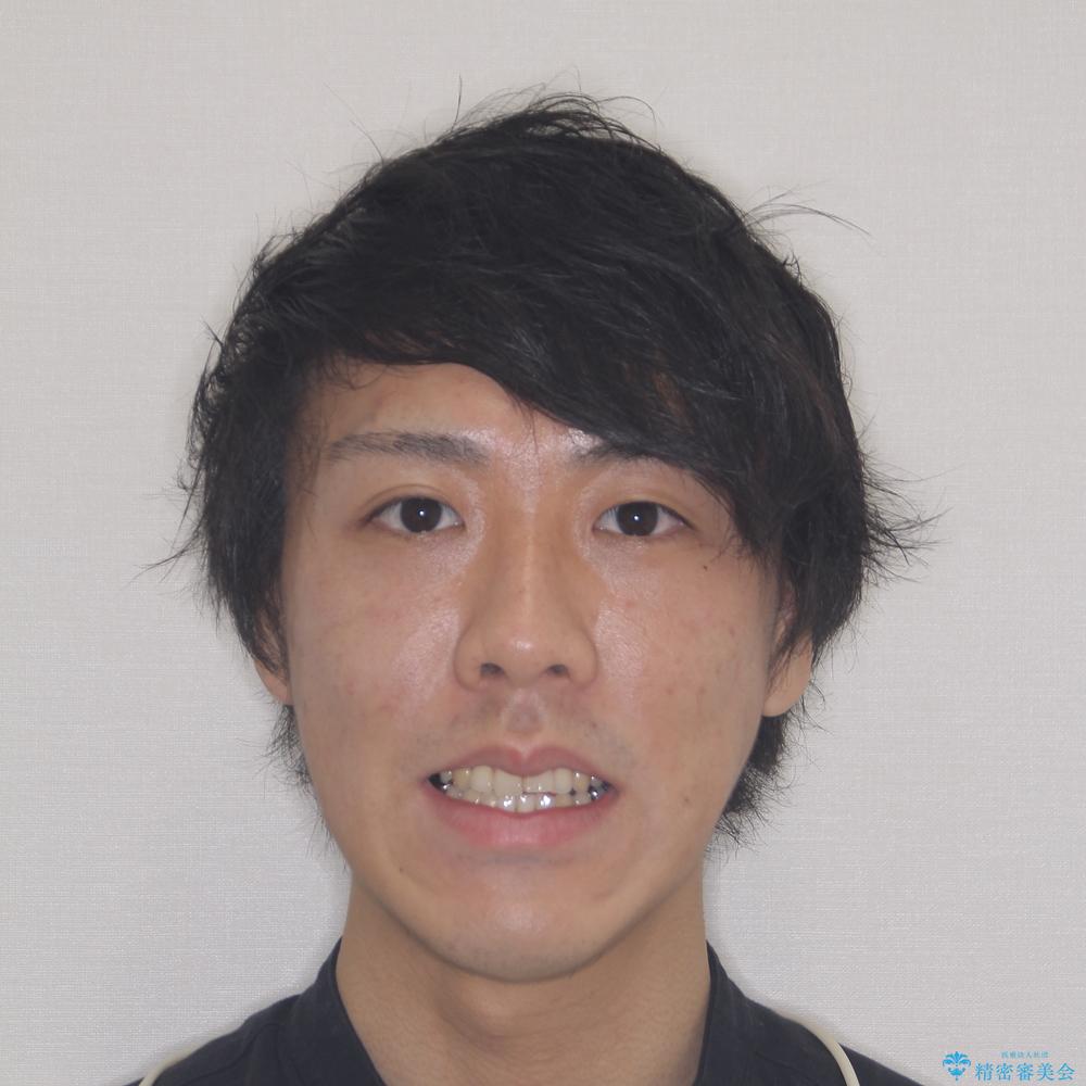 【モニター】舌のトレーニングを行いながら後戻りの再矯正の治療前(顔貌)