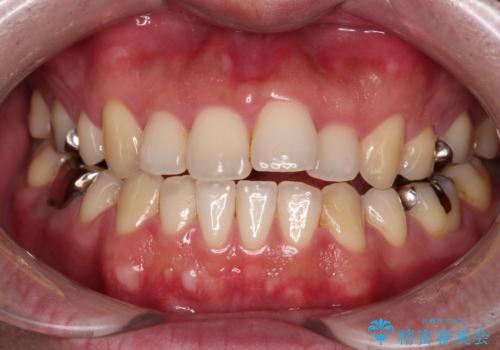 【モニター】舌のトレーニングを行いながら後戻りの再矯正の治療前