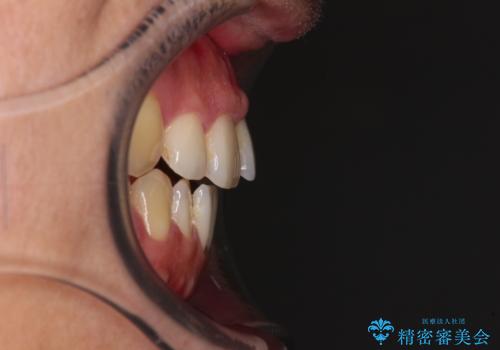 【モニター】舌のトレーニングを行いながら後戻りの再矯正の治療前